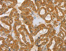 PDP1 Antibody - Immunohistochemistry of paraffin-embedded Human cervical cancer using PDP1 Polyclonal Antibody at dilution of 1:30.