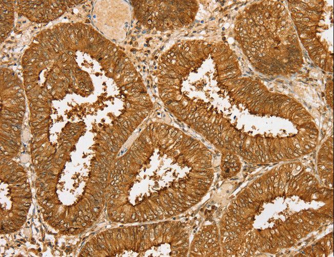 PDP1 Antibody - Immunohistochemistry of paraffin-embedded Human cervical cancer using PDP1 Polyclonal Antibody at dilution of 1:30.