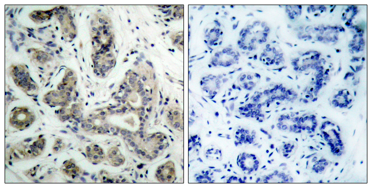 PDPK1 / PDK1 Antibody - Immunohistochemistry analysis of paraffin-embedded human breast carcinoma tissue, using PDK1 Antibody. The picture on the right is blocked with the synthesized peptide.