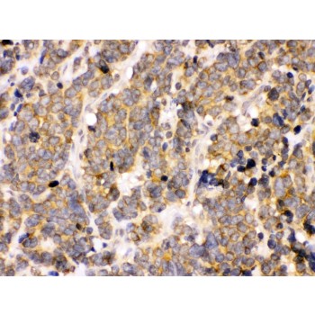 PDPK1 / PDK1 Antibody - PDPK1 antibody IHC-paraffin. IHC(P): Human Lung Cancer Tissue.