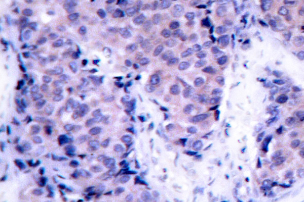 PDPK1 / PDK1 Antibody - IHC of PDK1 (K235) pAb in paraffin-embedded human breast carcinoma tissue.