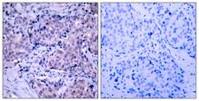 PDPK1 / PDK1 Antibody - Peptide - + Immunohistochemical analysis of paraffin- embedded human breast carcinoma tissue using PDK1 (Ab-241) antibody.