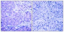 PDPK1 / PDK1 Antibody - Immunohistochemistry analysis of paraffin-embedded human breast carcinoma, using PDK1 (Phospho-Ser241) Antibody. The picture on the right is blocked with the phospho peptide.
