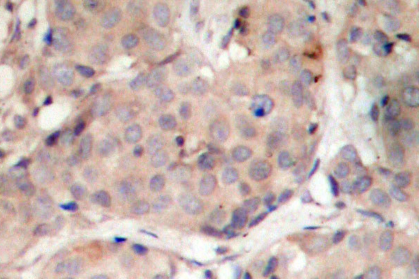 PDPK1 / PDK1 Antibody - IHC of p-PDK1 (S241) pAb in paraffin-embedded human breast carcinoma tissue.
