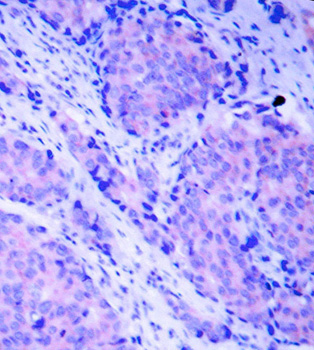 PDPK1 / PDK1 Antibody - Immunohistochemical analysis of paraffin-embedded human breast carcinoma tissue.