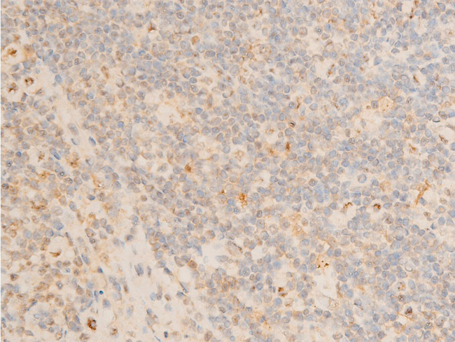 PDPK1 / PDK1 Antibody - 1:100 staining human appendix tissue by IHC-P. The tissue was formaldehyde fixed and a heat mediated antigen retrieval step in citrate buffer was performed. The tissue was then blocked and incubated with the antibody for 1.5 hours at 22°C. An HRP conjugated goat anti-rabbit antibody was used as the secondary.