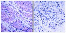 PDPK1 / PDK1 Antibody - P-Peptide - + Immunohistochemical analysis of paraffin- embedded human breast carcinoma tissue using PDK1 (phospho-Ser241) antibody.