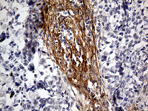 PDPN / Podoplanin Antibody - Immunohistochemical staining of paraffin-embedded Carcinoma of Human lung tissue using anti-PDPN mouse monoclonal antibody. (Heat-induced epitope retrieval by 1mM EDTA in 10mM Tris buffer. (pH8.5) at 120°C for 3 min. (1:2000)