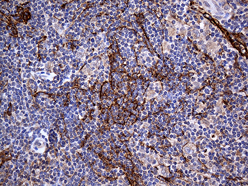 PDPN / Podoplanin Antibody - Immunohistochemical staining of paraffin-embedded Human lymphoma tissue using anti-PDPN mouse monoclonal antibody. (Heat-induced epitope retrieval by 1mM EDTA in 10mM Tris buffer. (pH8.5) at 120°C for 3 min. (1:2000)