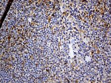PDPN / Podoplanin Antibody - Immunohistochemical staining of paraffin-embedded Human lymphoma tissue using anti-PDPN mouse monoclonal antibody. (Heat-induced epitope retrieval by 1mM EDTA in 10mM Tris buffer. (pH8.5) at 120°C for 3 min. (1:500)