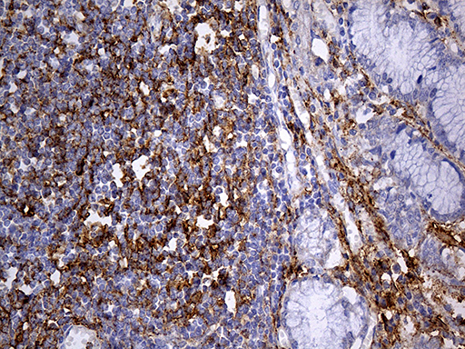 PDPN / Podoplanin Antibody - Immunohistochemical staining of paraffin-embedded Human Gastric Carcinoma using anti-PDPN mouse monoclonal antibody. (Heat-induced epitope retrieval by 1mM EDTA in 10mM Tris buffer. (pH8.5) at 120°C for 3 min. (1:500)