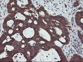 PDRG1 Antibody - IHC of paraffin-embedded Adenocarcinoma of Human colon tissue using anti-PDRG1 mouse monoclonal antibody. (Heat-induced epitope retrieval by 10mM citric buffer, pH6.0, 100C for 10min).