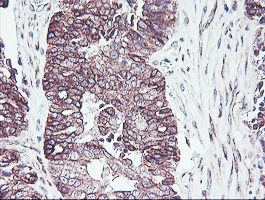 PDRG1 Antibody - IHC of paraffin-embedded Adenocarcinoma of Human ovary tissue using anti-PDRG1 mouse monoclonal antibody. (Heat-induced epitope retrieval by 10mM citric buffer, pH6.0, 100C for 10min).