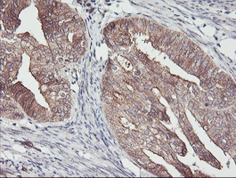 PDRG1 Antibody - IHC of paraffin-embedded Adenocarcinoma of Human endometrium tissue using anti-PDRG1 mouse monoclonal antibody. (Heat-induced epitope retrieval by 10mM citric buffer, pH6.0, 100C for 10min).