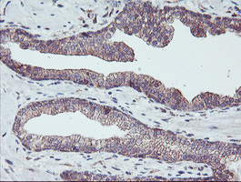 PDRG1 Antibody - IHC of paraffin-embedded Carcinoma of Human prostate tissue using anti-PDRG1 mouse monoclonal antibody. (Heat-induced epitope retrieval by 10mM citric buffer, pH6.0, 100C for 10min).