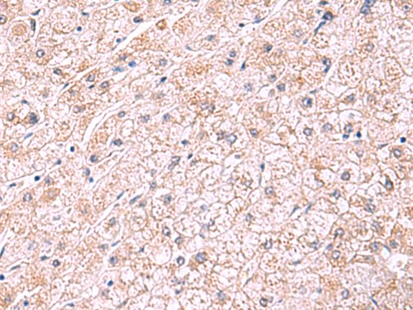 PDRG1 Antibody - Immunohistochemistry of paraffin-embedded Human liver cancer tissue  using PDRG1 Polyclonal Antibody at dilution of 1:75(×200)