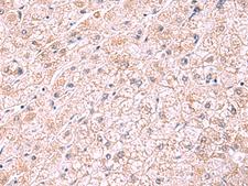 PDRG1 Antibody - Immunohistochemistry of paraffin-embedded Human liver cancer tissue  using PDRG1 Polyclonal Antibody at dilution of 1:75(×200)