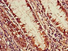 PDS5A Antibody - Immunohistochemistry of paraffin-embedded human colon cancer using PDS5A Antibody at dilution of 1:100