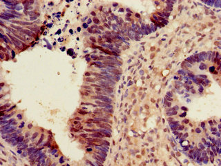 PDS5A Antibody - Immunohistochemistry of paraffin-embedded human ovarian cancer using PDS5A Antibody at dilution of 1:100