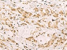 PDS5A Antibody - Immunohistochemistry of paraffin-embedded Human gastric cancer tissue  using PDS5A Polyclonal Antibody at dilution of 1:90(×200)