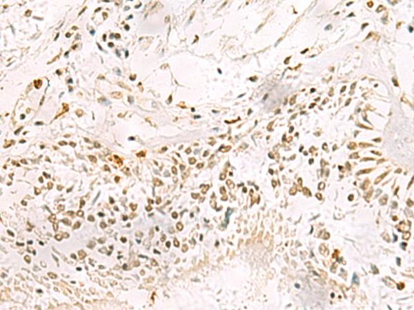 PDS5A Antibody - Immunohistochemistry of paraffin-embedded Human lung cancer tissue  using PDS5A Polyclonal Antibody at dilution of 1:90(×200)