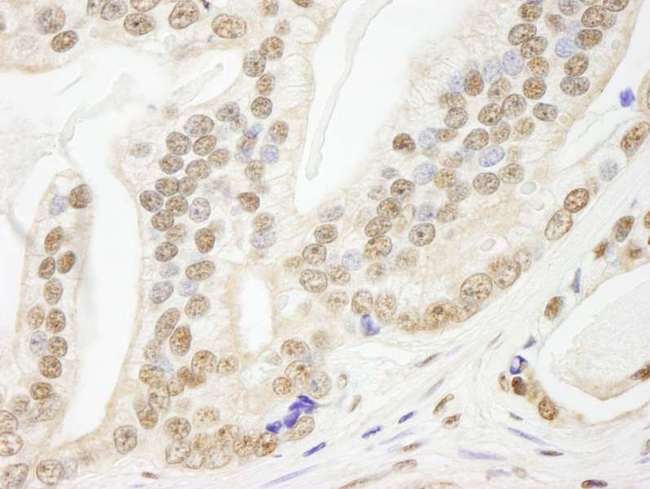 PDS5B / AS3 Antibody - Detection of Human Pds5B by Immunohistochemistry. Sample: FFPE section of human prostate carcinoma. Antibody: Affinity purified rabbit anti-Pds5B used at a dilution of 1:250.