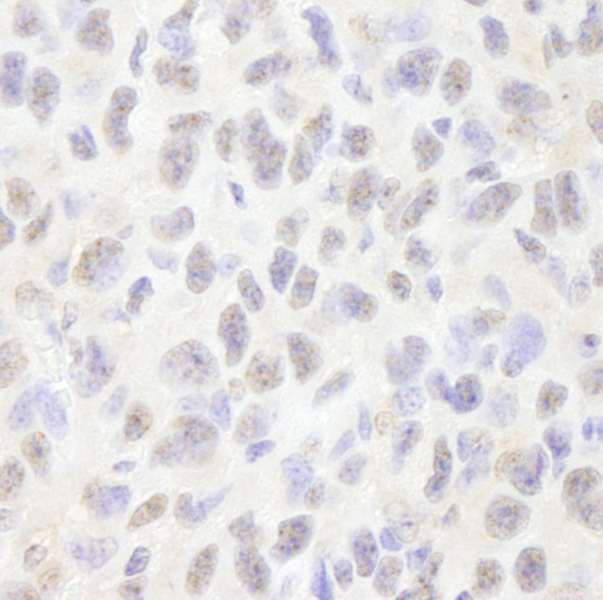 PDS5B / AS3 Antibody - Detection of Mouse Pds5B by Immunohistochemistry. Sample: FFPE section of mouse squamous cell carcinoma. Antibody: Affinity purified rabbit anti-Pds5B used at a dilution of 1:250.