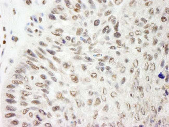 PDS5B / AS3 Antibody - Detection of Human Pds5B by Immunohistochemistry. Sample: FFPE section of human laryngeal squamous cell carcinoma. Antibody: Affinity purified rabbit anti-Pds5B used at a dilution of 1:200 (1 ug/ml). Detection: DAB.