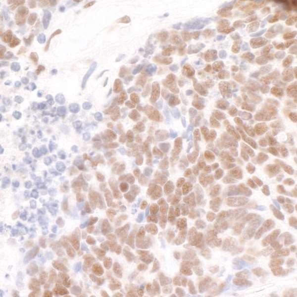 PDS5B / AS3 Antibody - Detection of human Pds5B by immunohistochemistry. Sample: FFPE section of human lung small cell carcinoma. Antibody: Affinity purified rabbit anti- Pds5B used at a dilution of 1:200 (1µg/ml). Detection: DAB