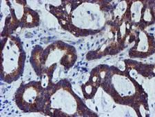 PDSS2 / DLP1 Antibody - IHC of paraffin-embedded Adenocarcinoma of Human colon tissue using anti-PDSS2 mouse monoclonal antibody.