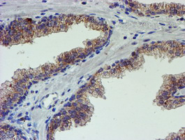 PDSS2 / DLP1 Antibody - IHC of paraffin-embedded Carcinoma of Human prostate tissue using anti-PDSS2 mouse monoclonal antibody.