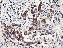 PDSS2 / DLP1 Antibody - IHC of paraffin-embedded Carcinoma of Human lung tissue using anti-PDSS2 mouse monoclonal antibody.