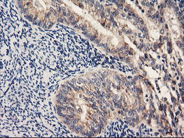 PDSS2 / DLP1 Antibody - IHC of paraffin-embedded Adenocarcinoma of Human endometrium tissue using anti-PDSS2 mouse monoclonal antibody.