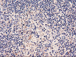 PDSS2 / DLP1 Antibody - IHC of paraffin-embedded Human lymphoma tissue using anti-PDSS2 mouse monoclonal antibody.