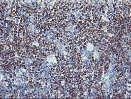 PDSS2 / DLP1 Antibody - IHC of paraffin-embedded Human lymphoma tissue using anti-PDSS2 mouse monoclonal antibody.