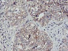 PDSS2 / DLP1 Antibody - IHC of paraffin-embedded Adenocarcinoma of Human ovary tissue using anti-PDSS2 mouse monoclonal antibody.