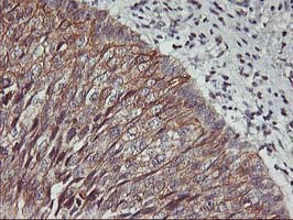 PDSS2 / DLP1 Antibody - IHC of paraffin-embedded Carcinoma of Human bladder tissue using anti-PDSS2 mouse monoclonal antibody. (Heat-induced epitope retrieval by 10mM citric buffer, pH6.0, 100C for 10min).