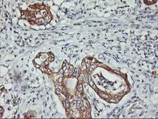 PDSS2 / DLP1 Antibody - IHC of paraffin-embedded Carcinoma of Human pancreas tissue using anti-PDSS2 mouse monoclonal antibody. (Heat-induced epitope retrieval by 10mM citric buffer, pH6.0, 100C for 10min).