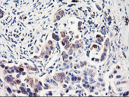 PDSS2 / DLP1 Antibody - IHC of paraffin-embedded Carcinoma of Human lung tissue using anti-PDSS2 mouse monoclonal antibody.