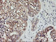 PDSS2 / DLP1 Antibody - IHC of paraffin-embedded Adenocarcinoma of Human ovary tissue using anti-PDSS2 mouse monoclonal antibody. (Heat-induced epitope retrieval by 10mM citric buffer, pH6.0, 100C for 10min).