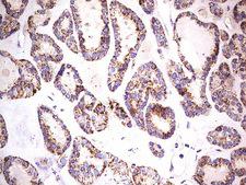 PDSS2 / DLP1 Antibody - Immunohistochemical staining of paraffin-embedded Carcinoma of Human thyroid tissue using anti-PDSS2 mouse monoclonal antibody.  heat-induced epitope retrieval by 1 mM EDTA in 10mM Tris, pH8.0, 120C for 3min)