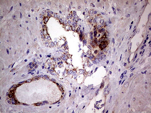 PDSS2 / DLP1 Antibody - Immunohistochemical staining of paraffin-embedded Human prostate tissue using anti-PDSS2 mouse monoclonal antibody.  heat-induced epitope retrieval by 1 mM EDTA in 10mM Tris, pH8.0, 120C for 3min)