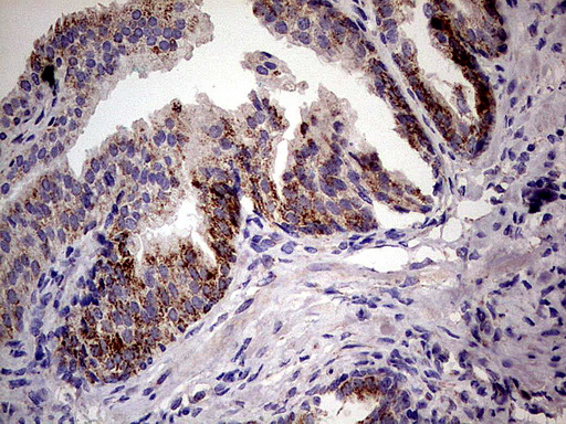 PDSS2 / DLP1 Antibody - Immunohistochemical staining of paraffin-embedded Carcinoma of Human prostate tissue using anti-PDSS2 mouse monoclonal antibody.  heat-induced epitope retrieval by 1 mM EDTA in 10mM Tris, pH8.0, 120C for 3min)