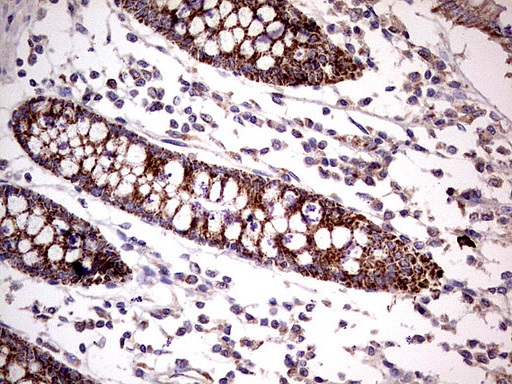 PDSS2 / DLP1 Antibody - Immunohistochemical staining of paraffin-embedded Human colon tissue using anti-PDSS2 mouse monoclonal antibody.  heat-induced epitope retrieval by 1 mM EDTA in 10mM Tris, pH8.0, 120C for 3min)