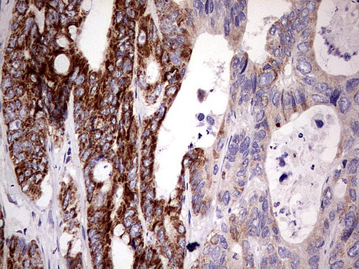 PDSS2 / DLP1 Antibody - Immunohistochemical staining of paraffin-embedded Adenocarcinoma of Human colon tissue using anti-PDSS2 mouse monoclonal antibody.  heat-induced epitope retrieval by 1 mM EDTA in 10mM Tris, pH8.0, 120C for 3min)