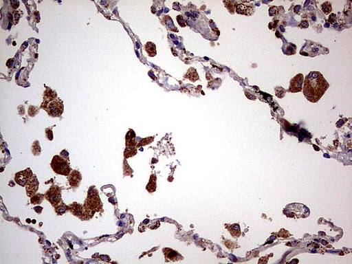 PDSS2 / DLP1 Antibody - Immunohistochemical staining of paraffin-embedded Human lung tissue using anti-PDSS2 mouse monoclonal antibody.  heat-induced epitope retrieval by 1 mM EDTA in 10mM Tris, pH8.0, 120C for 3min)