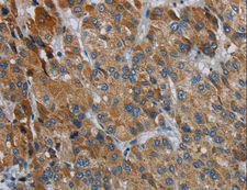 PDSS2 / DLP1 Antibody - Immunohistochemistry of paraffin-embedded Human liver cancer using PDSS2 Polyclonal Antibody at dilution of 1:30.