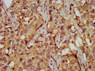 PDSS2 / DLP1 Antibody - Immunohistochemistry image at a dilution of 1:200 and staining in paraffin-embedded human liver cancer performed on a Leica BondTM system. After dewaxing and hydration, antigen retrieval was mediated by high pressure in a citrate buffer (pH 6.0) . Section was blocked with 10% normal goat serum 30min at RT. Then primary antibody (1% BSA) was incubated at 4 °C overnight. The primary is detected by a biotinylated secondary antibody and visualized using an HRP conjugated SP system.