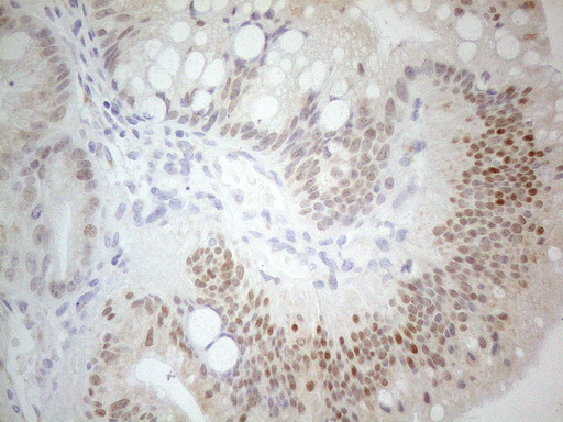 PDX1 Antibody - Immunohistochemical staining of paraffin-embedded Carcinoma of Human pancreas tissue using anti-PDX1 mouse monoclonal antibody. (Heat-induced epitope retrieval by 1mM EDTA in 10mM Tris buffer. (pH8.5) at 120°C for 3 min. (1:150)