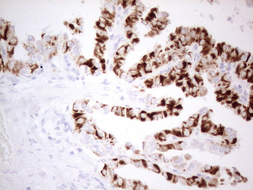 PDX1 Antibody - Immunohistochemical staining of paraffin-embedded Carcinoma of Human thyroid tissue using anti-PDX1 mouse monoclonal antibody. (Heat-induced epitope retrieval by 1mM EDTA in 10mM Tris buffer. (pH8.5) at 120°C for 3 min. (1:150)